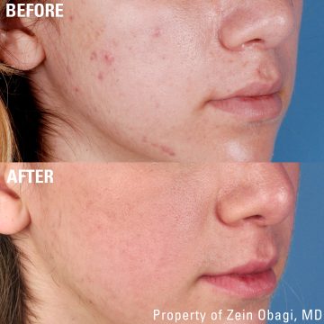 ACNE5