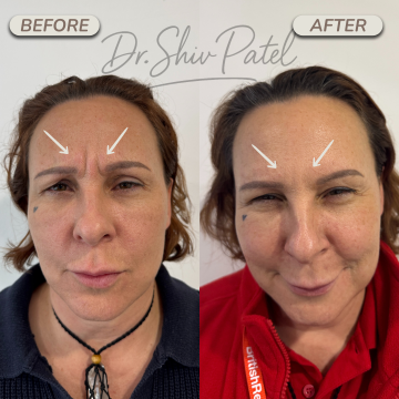 ANTI-WRINKLE (FROWN)