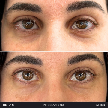 Ameela-Eyes---3-months