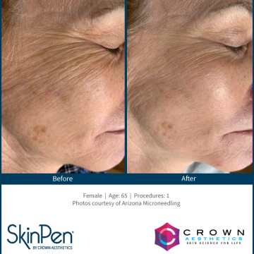 BA-SkinPen-FLAW-KH-Face-ArizonaMicroneedling-1treatment-65YO