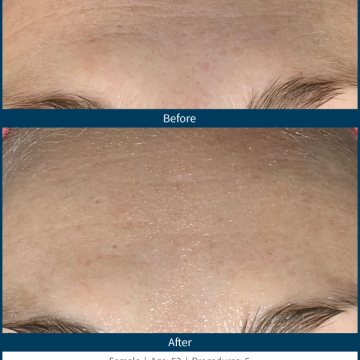 BA-SkinPen-FLAW-LG-Forehead-ArizonaMicroneedling-5treatments-53YO