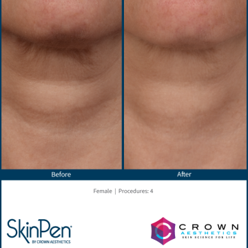 BA-SkinPen-FLAW_002_neck_Female