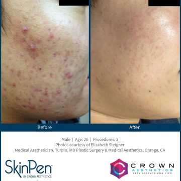 BA acne scars 2