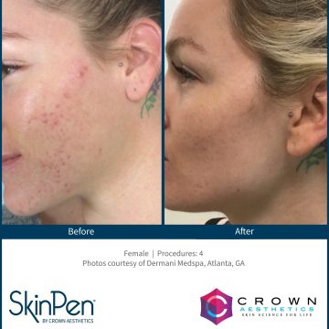 BA acne scars 4