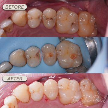 Composite Fillings