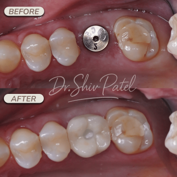 Copy of Implant crownsbridge