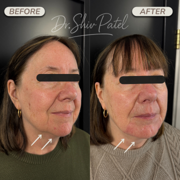 FILLER (JOWLS)