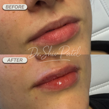 FILLER (LIPS)