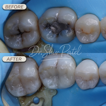 FILLINGS X2