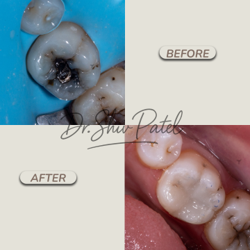 Filling (2)