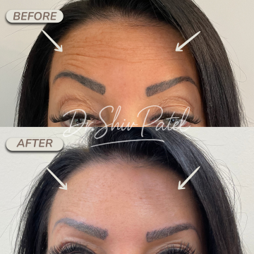 Forehead Botox