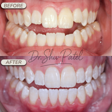 GP Invis + Whitening