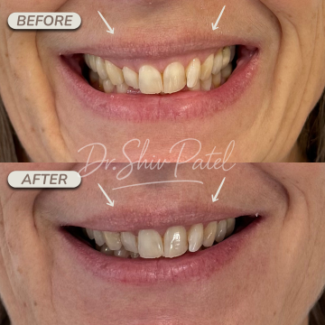 Gummy Smile Botox (2)