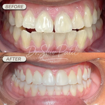 Invisalign