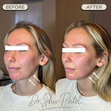 Jawline Filler