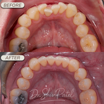 LOWER INVISALIGN