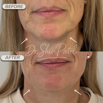 Masking Jowl