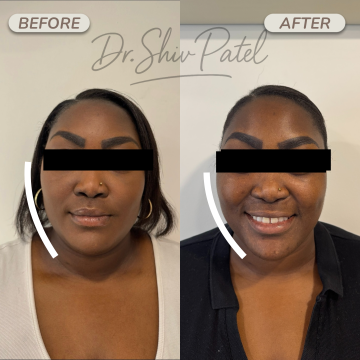 Masseter botox 2