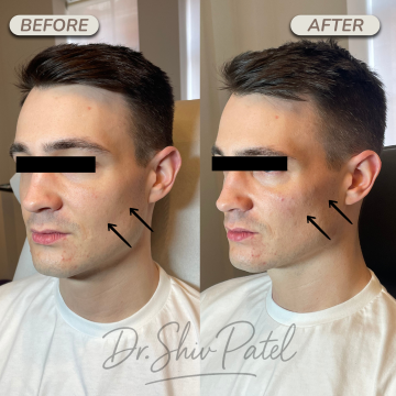 Mens Cheek Filler