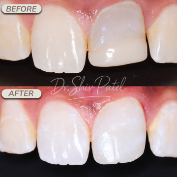 UL1 Internal Bleaching