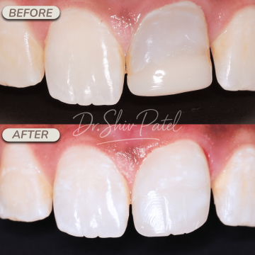 UL1 Internal Bleaching