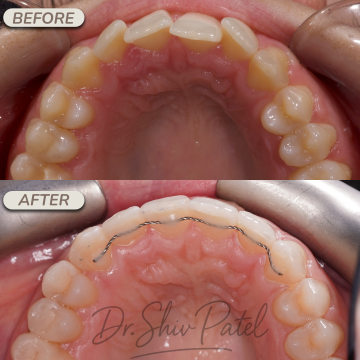 UPPER INVISALIGN