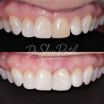 Veneer