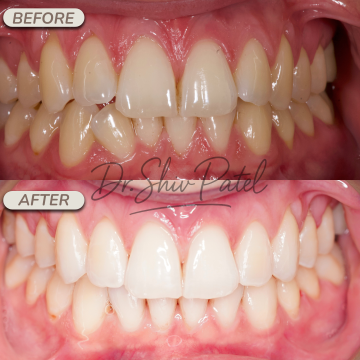 Whitening 1