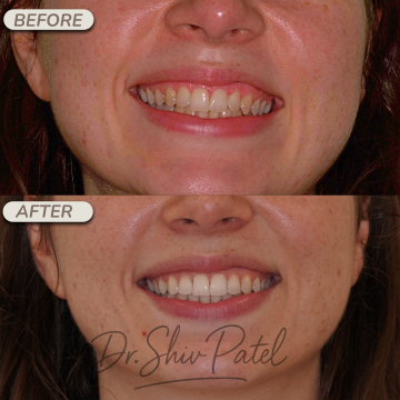 Whitening 3